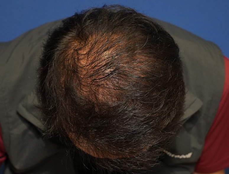 60代男性T.Mさんの頭部写真2（術後1年）