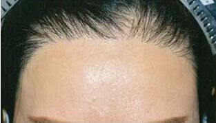 30代 女性 A.Y.さん 生え際の自毛植毛（NC-MIRAI法） 1,100株の症例（施術後）