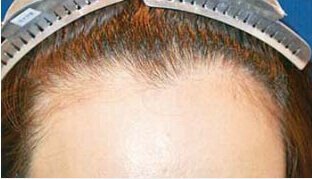 30代 女性 A.Y.さん 生え際の自毛植毛（NC-MIRAI法） 1,100株の症例（施術前）