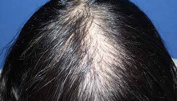 40代 女性 K.M.さん 頭頂部の自毛植毛（MIRAI法） 1,500株の症例（施術前）