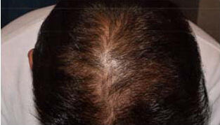 40代 男性 K.T.さん 頭頂部の自毛植毛（NC-MIRAI法） 700株の症例（施術後）