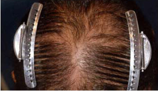 40代 男性 K.T.さん 頭頂部の自毛植毛（NC-MIRAI法） 700株の症例（施術前）