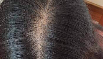 30代 女性 M.K.さん 頭頂部の自毛植毛（MIRAI法） 200株の症例（施術後）