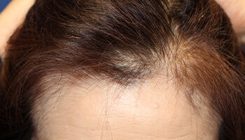 50代 女性 O.R.さん 生え際の自毛植毛（NC-MIRAI法） 1,000株の症例（施術前）