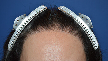 40代 女性 O.K.さん 生え際・前頭部の自毛植毛（NC-MIRAI法） 1,600株の症例（施術後）