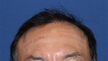 40代 男性 S.R.さん　生え際・前頭部 自毛植毛（MIRAI法） 1,500株の症例（施術後）