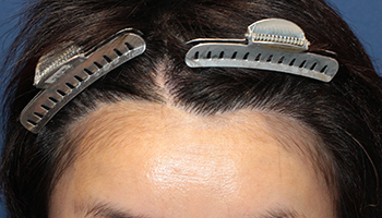 牽引性脱毛症の症例 30代 女性 施術後