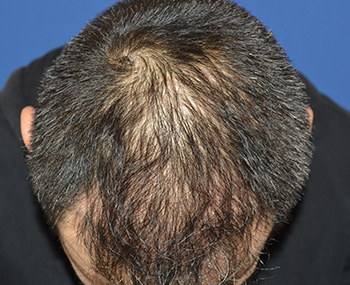 	30代 男性 S.M.さん 生え際・前頭部・頭頂部 自毛植毛（MIRAI法） 2,400株の症例（施術後）