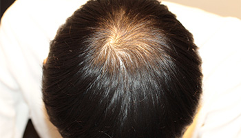 20代 男性 N.K.さん 頭頂部 自毛植毛（MIRAI法） 800株｜自毛植毛の症例の症例（手術前）_01