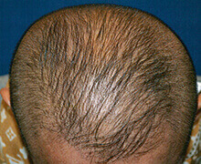 頭頂部の自毛植毛症例写真 50代男性 1,230株 治療後