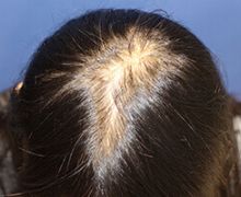 女性の自毛植毛症例写真 40代女性 1,500株 治療前