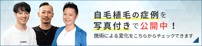 自毛植毛の症例・インタビュー_バナー