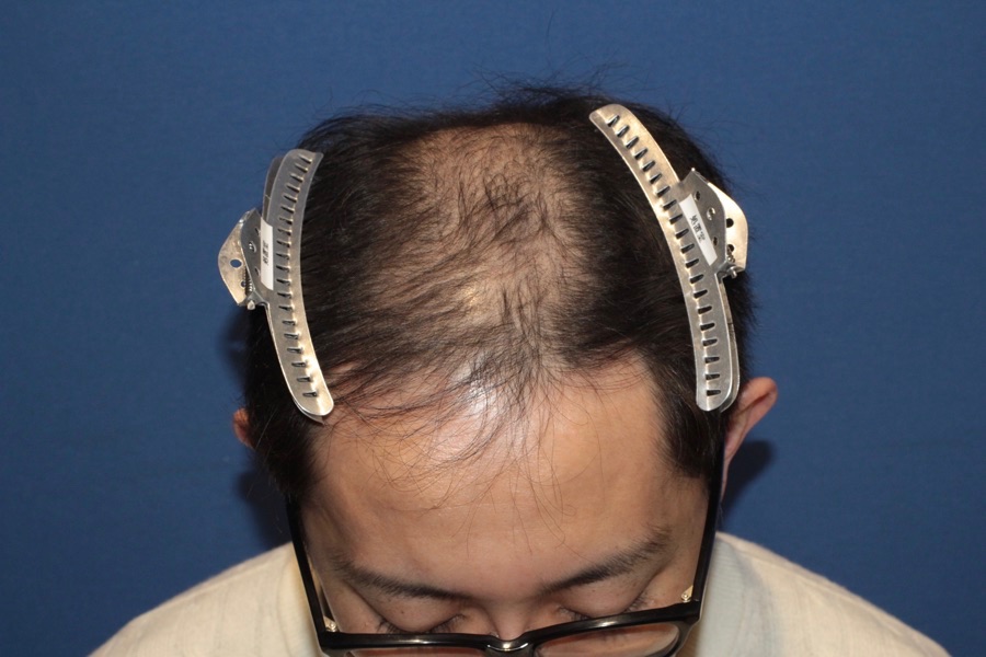 男性の生え際症例（施術前）