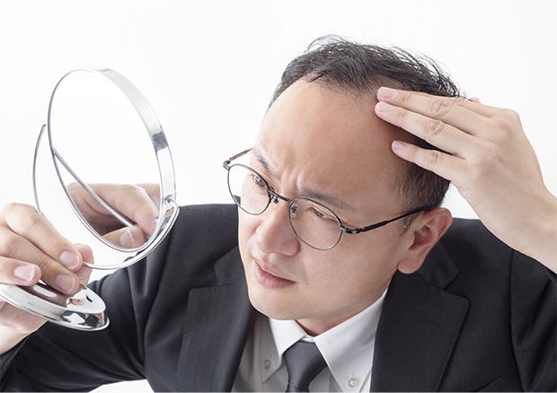 AGAの特徴は？