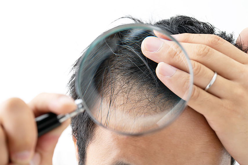 分け目が薄い？薄毛の7つの原因と分け目をふわりと回復する画期的な治療法も解説
