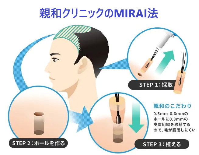 親和クリニックのMIRAI法
