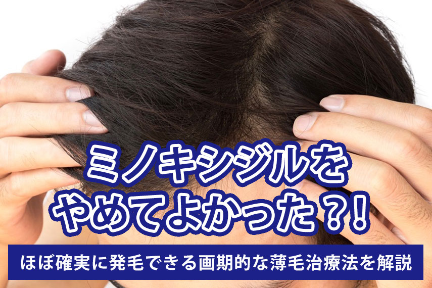 ミノキシジルをやめてよかった？！ほぼ確実に発毛できる画期的な薄毛治療法を解説