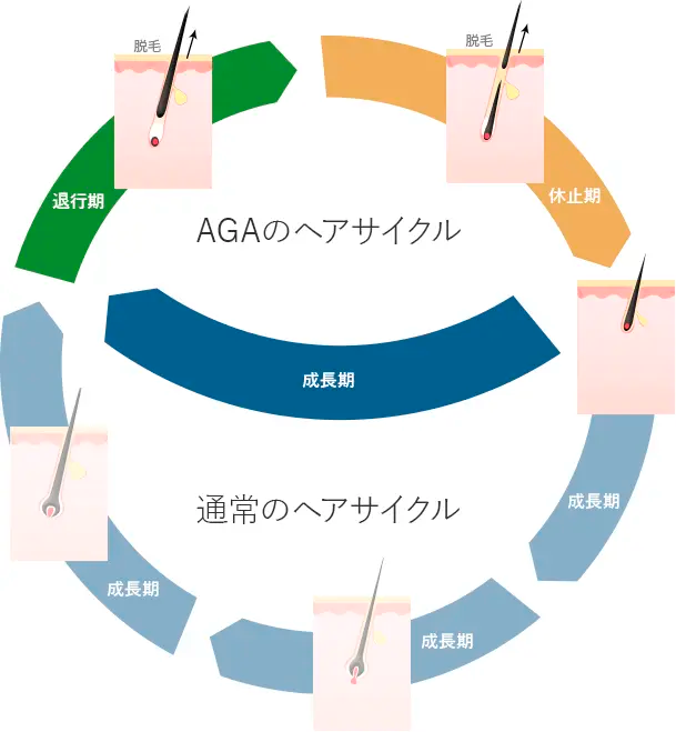 AGAのサイクル