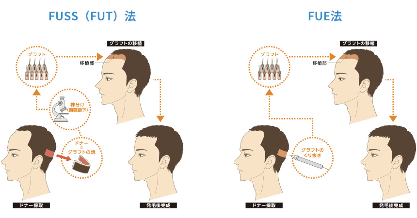 FUSS（FUT）法、FUE法