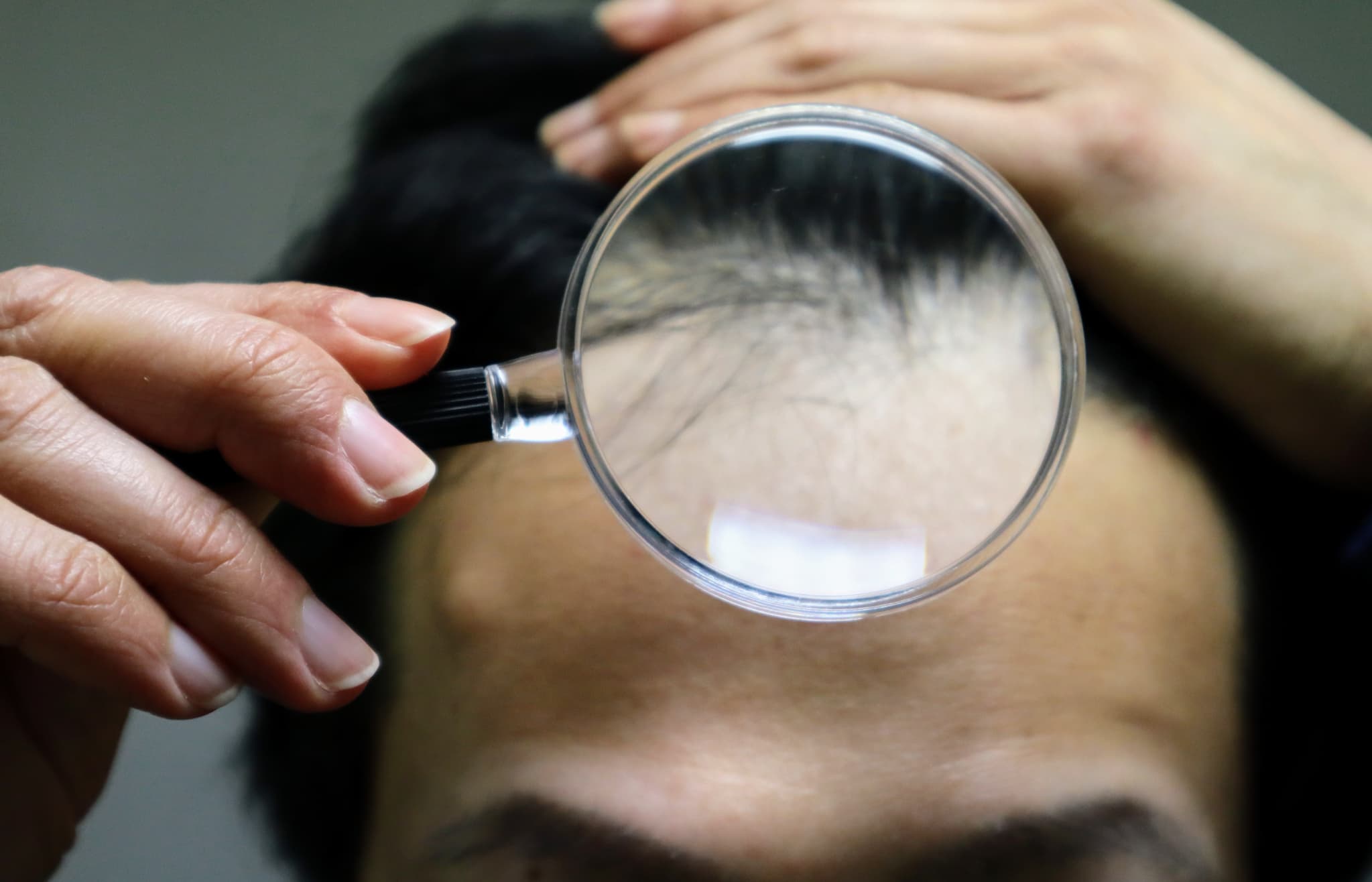 ルーペで生え際の頭皮を確認している様子