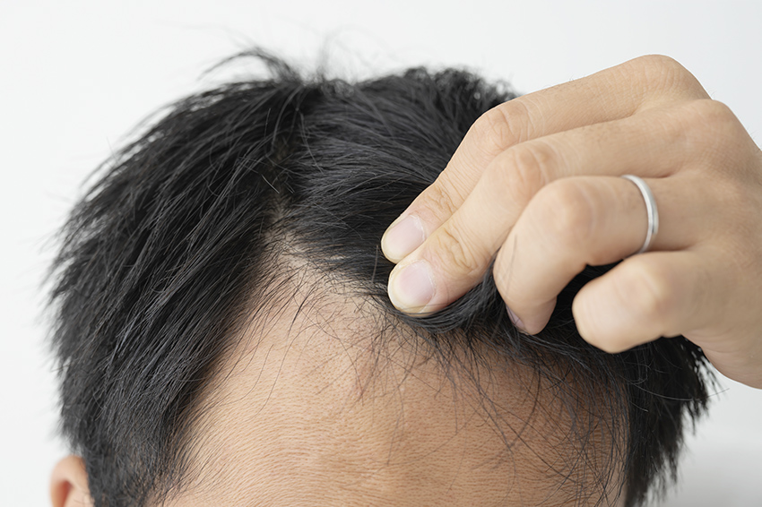 前髪が薄いなら？生え際の薄毛を改善する画期的な治療法