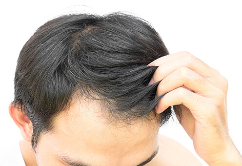 自毛植毛の株数（グラフト数）とは？理想の髪型に必要な株数の決め方