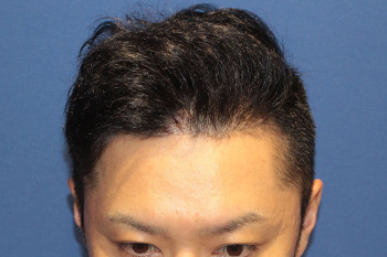 施術後12ヶ月の頭部の様子