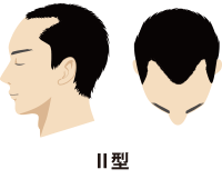 Ⅱ型