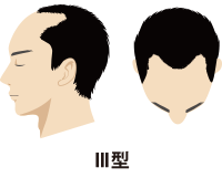 Ⅲ型