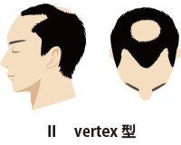 Ⅱvertex型