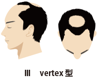 Ⅲvertex型