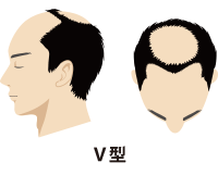 Ⅴ型