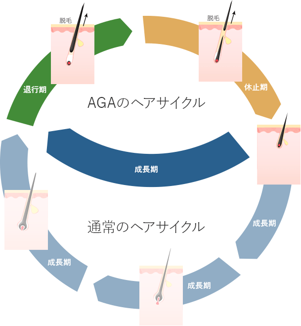 AGAのヘアサイクル