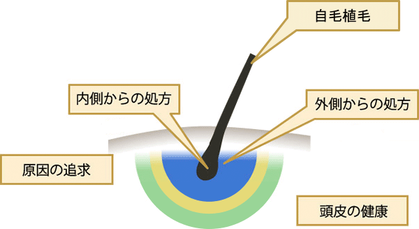 薄毛の治療法