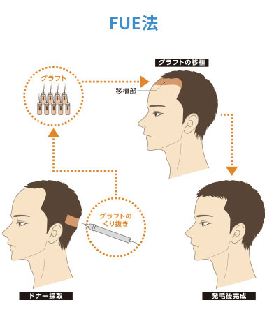 FUE法の図解