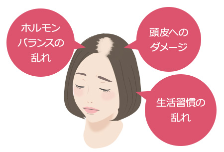 女性の薄毛の原因は様々