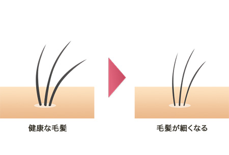 女性の薄毛の原因のイラスト