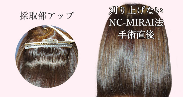 親和クリニックなら周囲に気づかれずに植毛可能