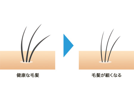 男性の薄毛の原因のイラスト