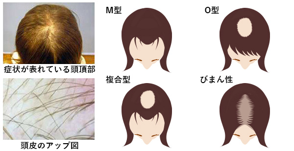 びまん性脱毛症とは