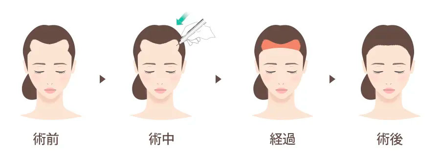 女性の自毛植毛