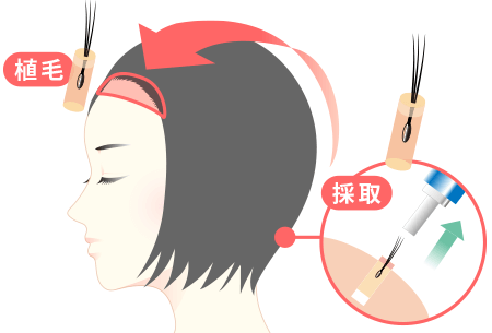 女性の自毛植毛イラスト