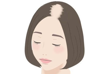 びまん性脱毛症