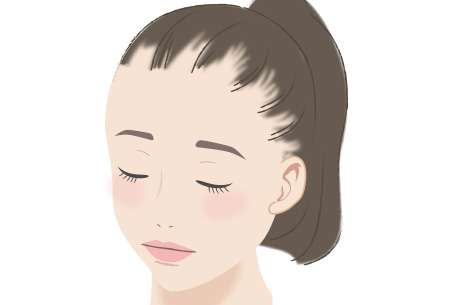 牽引性脱毛症