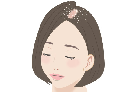 脂漏性脱毛症