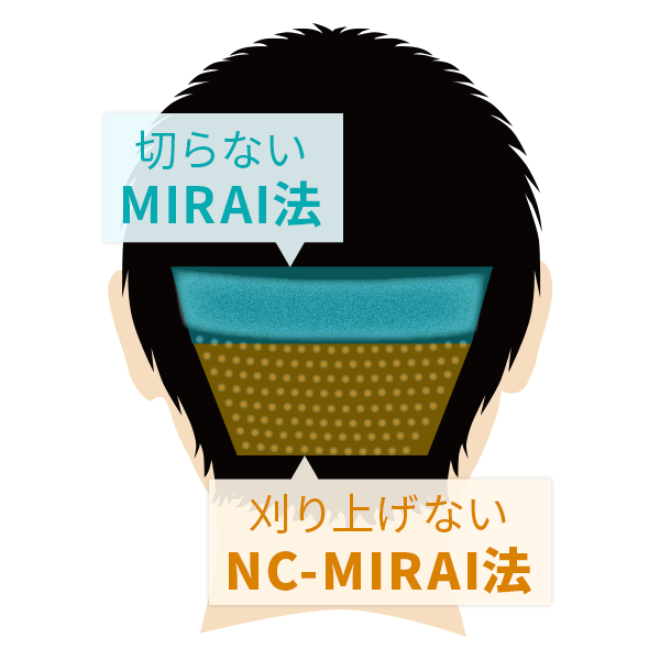 2つを融合した自毛植毛 United MIRAI法