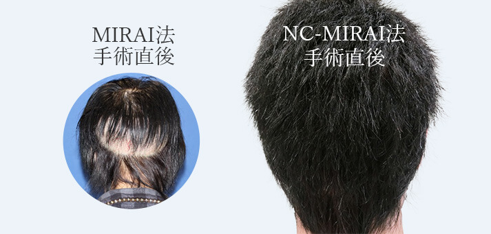 NC-MIRAI法