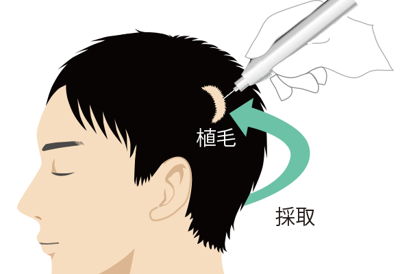 けが・傷跡・火傷跡への植毛手術のイラスト