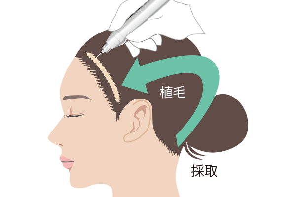 フェイスリフトなどの手術跡への修正植毛手術のイラスト