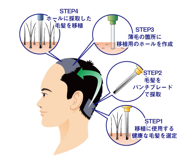 自毛植毛のフロー